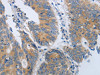 The image on the left is immunohistochemistry of paraffin-embedded Human colon cancer tissue using CSB-PA086078 (MME Antibody) at dilution 1/45, on the right is treated with synthetic peptide. (Original magnification: ×200)