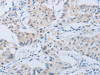 The image on the left is immunohistochemistry of paraffin-embedded Human lung cancer tissue using CSB-PA086078 (MME Antibody) at dilution 1/45, on the right is treated with synthetic peptide. (Original magnification: ×200)