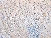 The image on the left is immunohistochemistry of paraffin-embedded Human liver cancer tissue using CSB-PA224370 (NFAT5 Antibody) at dilution 1/25, on the right is treated with synthetic peptide. (Original magnification: ×200)
