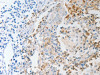 The image on the left is immunohistochemistry of paraffin-embedded Human cervical cancer tissue using CSB-PA785439 (NFKB2 Antibody) at dilution 1/20, on the right is treated with synthetic peptide. (Original magnification: ×200)