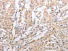 The image on the left is immunohistochemistry of paraffin-embedded Human lung cancer tissue using CSB-PA980278 (INA Antibody) at dilution 1/30, on the right is treated with synthetic peptide. (Original magnification: ×200)