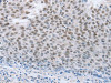 The image on the left is immunohistochemistry of paraffin-embedded Human liver cancer tissue using CSB-PA248806 (NEUROG2 Antibody) at dilution 1/15, on the right is treated with synthetic peptide. (Original magnification: ×200)