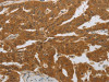 The image on the left is immunohistochemistry of paraffin-embedded Human ovarian cancer tissue using CSB-PA912806 (NIT2 Antibody) at dilution 1/40, on the right is treated with synthetic peptide. (Original magnification: ×200)