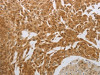 The image on the left is immunohistochemistry of paraffin-embedded Human cervical cancer tissue using CSB-PA912806 (NIT2 Antibody) at dilution 1/40, on the right is treated with synthetic peptide. (Original magnification: ×200)