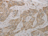 The image on the left is immunohistochemistry of paraffin-embedded Human esophagus cancer tissue using CSB-PA094894 (TAC1 Antibody) at dilution 1/20, on the right is treated with synthetic peptide. (Original magnification: ×200)