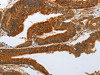 The image on the left is immunohistochemistry of paraffin-embedded Human colon cancer tissue using CSB-PA586591 (NOTCH3 Antibody) at dilution 1/25, on the right is treated with synthetic peptide. (Original magnification: ×200)