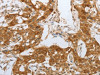 The image on the left is immunohistochemistry of paraffin-embedded Human lung cancer tissue using CSB-PA052191 (NPY1R Antibody) at dilution 1/25, on the right is treated with synthetic peptide. (Original magnification: ×200)