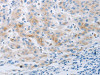 The image on the left is immunohistochemistry of paraffin-embedded Human liver cancer tissue using CSB-PA131945 (NPY2R Antibody) at dilution 1/20, on the right is treated with synthetic peptide. (Original magnification: ×200)