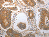 The image on the left is immunohistochemistry of paraffin-embedded Human colon cancer tissue using CSB-PA890070 (NQO1 Antibody) at dilution 1/40, on the right is treated with synthetic peptide. (Original magnification: ×200)