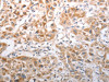 The image on the left is immunohistochemistry of paraffin-embedded Human lung cancer tissue using CSB-PA890070 (NQO1 Antibody) at dilution 1/40, on the right is treated with synthetic peptide. (Original magnification: ×200)