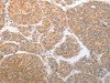 The image on the left is immunohistochemistry of paraffin-embedded Human liver cancer tissue using CSB-PA102829 (NQO1 Antibody) at dilution 1/25, on the right is treated with synthetic peptide. (Original magnification: ×200)