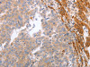 The image on the left is immunohistochemistry of paraffin-embedded Human ovarian cancer tissue using CSB-PA678879 (NRTN Antibody) at dilution 1/60, on the right is treated with synthetic peptide. (Original magnification: ×200)