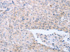 The image on the left is immunohistochemistry of paraffin-embedded Human ovarian cancer tissue using CSB-PA219834 (NRTN Antibody) at dilution 1/40, on the right is treated with synthetic peptide. (Original magnification: ×200)