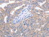 The image on the left is immunohistochemistry of paraffin-embedded Human cervical cancer tissue using CSB-PA219834 (NRTN Antibody) at dilution 1/40, on the right is treated with synthetic peptide. (Original magnification: ×200)