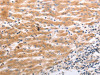 The image on the left is immunohistochemistry of paraffin-embedded Human liver cancer tissue using CSB-PA797469 (HCRTR1 Antibody) at dilution 1/70, on the right is treated with synthetic peptide. (Original magnification: ×200)