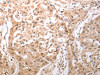 The image on the left is immunohistochemistry of paraffin-embedded Human lung cancer tissue using CSB-PA153820 (HCRTR1 Antibody) at dilution 1/100, on the right is treated with synthetic peptide. (Original magnification: ×200)
