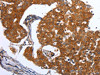 The image on the left is immunohistochemistry of paraffin-embedded Human breast cancer tissue using CSB-PA439945 (MAP2K1 Antibody) at dilution 1/25, on the right is treated with synthetic peptide. (Original magnification: ×200)