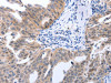 The image on the left is immunohistochemistry of paraffin-embedded Human ovarian cancer tissue using CSB-PA439945 (MAP2K1 Antibody) at dilution 1/25, on the right is treated with synthetic peptide. (Original magnification: ×200)