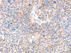 The image on the left is immunohistochemistry of paraffin-embedded Human liver cancer tissue using CSB-PA175450 (PAFAH2 Antibody) at dilution 1/80, on the right is treated with synthetic peptide. (Original magnification: ×200)