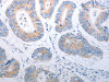 The image on the left is immunohistochemistry of paraffin-embedded Human colon cancer tissue using CSB-PA238998 (PAK1 Antibody) at dilution 1/40, on the right is treated with synthetic peptide. (Original magnification: ×200)