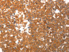 The image on the left is immunohistochemistry of paraffin-embedded Human breast cancer tissue using CSB-PA293075 (PPAP2C Antibody) at dilution 1/40, on the right is treated with synthetic peptide. (Original magnification: ×200)