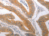 The image on the left is immunohistochemistry of paraffin-embedded Human colon cancer tissue using CSB-PA293075 (PPAP2C Antibody) at dilution 1/40, on the right is treated with synthetic peptide. (Original magnification: ×200)