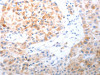 The image on the left is immunohistochemistry of paraffin-embedded Human lung cancer tissue using CSB-PA285192 (LPPR5 Antibody) at dilution 1/20, on the right is treated with synthetic peptide. (Original magnification: ×200)