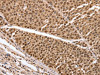 The image on the left is immunohistochemistry of paraffin-embedded Human liver cancer tissue using CSB-PA966699 (PARP1 Antibody) at dilution 1/20, on the right is treated with synthetic peptide. (Original magnification: ×200)
