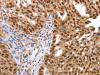 The image on the left is immunohistochemistry of paraffin-embedded Human ovarian cancer tissue using CSB-PA436053 (PARP1 Antibody) at dilution 1/40, on the right is treated with synthetic peptide. (Original magnification: ×200)