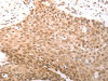 The image on the left is immunohistochemistry of paraffin-embedded Human cervical cancer tissue using CSB-PA034443 (PARP1 Antibody) at dilution 1/25, on the right is treated with synthetic peptide. (Original magnification: ×200)
