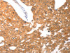 The image on the left is immunohistochemistry of paraffin-embedded Human breast cancer tissue using CSB-PA034443 (PARP1 Antibody) at dilution 1/25, on the right is treated with synthetic peptide. (Original magnification: ×200)