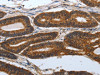 The image on the left is immunohistochemistry of paraffin-embedded Human colon cancer tissue using CSB-PA695661 (PDCD7 Antibody) at dilution 1/60, on the right is treated with synthetic peptide. (Original magnification: ×200)