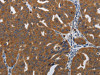 The image on the left is immunohistochemistry of paraffin-embedded Human ovarian cancer tissue using CSB-PA116985 (PDCD2 Antibody) at dilution 1/10, on the right is treated with synthetic peptide. (Original magnification: ×200)