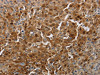 The image on the left is immunohistochemistry of paraffin-embedded Human cervical cancer tissue using CSB-PA116985 (PDCD2 Antibody) at dilution 1/10, on the right is treated with synthetic peptide. (Original magnification: ×200)