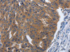 The image on the left is immunohistochemistry of paraffin-embedded Human ovarian cancer tissue using CSB-PA041073 (PDGFA Antibody) at dilution 1/70, on the right is treated with synthetic peptide. (Original magnification: ×200)