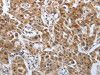 The image on the left is immunohistochemistry of paraffin-embedded Human lung cancer tissue using CSB-PA984889 (PDGFA Antibody) at dilution 1/40, on the right is treated with synthetic peptide. (Original magnification: ×200)