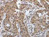 The image on the left is immunohistochemistry of paraffin-embedded Human lung cancer tissue using CSB-PA997074 (PDIA2 Antibody) at dilution 1/50, on the right is treated with synthetic peptide. (Original magnification: ×200)