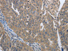 The image on the left is immunohistochemistry of paraffin-embedded Human ovarian cancer tissue using CSB-PA782127 (PMS2 Antibody) at dilution 1/50, on the right is treated with synthetic peptide. (Original magnification: ×200)