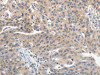 The image on the left is immunohistochemistry of paraffin-embedded Human ovarian cancer tissue using CSB-PA158058 (PRKD1 Antibody) at dilution 1/70, on the right is treated with synthetic peptide. (Original magnification: ×200)