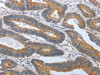 The image on the left is immunohistochemistry of paraffin-embedded Human colon cancer tissue using CSB-PA285011 (PGR Antibody) at dilution 1/30, on the right is treated with synthetic peptide. (Original magnification: ×200)