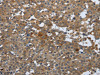 The image on the left is immunohistochemistry of paraffin-embedded Human breast cancer tissue using CSB-PA778835 (PGR Antibody) at dilution 1/25, on the right is treated with synthetic peptide. (Original magnification: ×200)