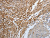The image on the left is immunohistochemistry of paraffin-embedded Human cervical cancer tissue using CSB-PA778835 (PGR Antibody) at dilution 1/25, on the right is treated with synthetic peptide. (Original magnification: ×200)