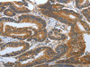 The image on the left is immunohistochemistry of paraffin-embedded Human colon cancer tissue using CSB-PA587709 (PSCA Antibody) at dilution 1/30, on the right is treated with synthetic peptide. (Original magnification: ×200)