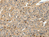The image on the left is immunohistochemistry of paraffin-embedded Human ovarian cancer tissue using CSB-PA443727 (S100A4 Antibody) at dilution 1/80, on the right is treated with synthetic peptide. (Original magnification: ×200)