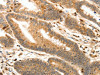 The image on the left is immunohistochemistry of paraffin-embedded Human colon cancer tissue using CSB-PA929601 (S100A4 Antibody) at dilution 1/30, on the right is treated with synthetic peptide. (Original magnification: ×200)