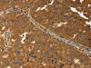 The image on the left is immunohistochemistry of paraffin-embedded Human ovarian cancer tissue using CSB-PA776176 (AMD1 Antibody) at dilution 1/30, on the right is treated with synthetic peptide. (Original magnification: ×200)