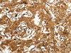 The image on the left is immunohistochemistry of paraffin-embedded Human lung cancer tissue using CSB-PA776176 (AMD1 Antibody) at dilution 1/30, on the right is treated with synthetic peptide. (Original magnification: ×200)