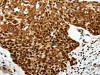 The image on the left is immunohistochemistry of paraffin-embedded Human cervical cancer tissue using CSB-PA409848 (SCN1A Antibody) at dilution 1/40, on the right is treated with synthetic peptide. (Original magnification: ×200)