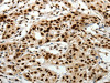 The image on the left is immunohistochemistry of paraffin-embedded Human lung cancer tissue using CSB-PA409848 (SCN1A Antibody) at dilution 1/40, on the right is treated with synthetic peptide. (Original magnification: ×200)