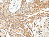 The image on the left is immunohistochemistry of paraffin-embedded Human breast cancer tissue using CSB-PA591668 (SCN11A Antibody) at dilution 1/40, on the right is treated with synthetic peptide. (Original magnification: ×200) The image on the left is immunohistochemistry of paraffin-embedded Human breast cancer tissue using CSB-PA591668 (SCN11A Antibody) at dilution 1/40, on the right is treated with synthetic peptide. (Original magnification: ×200)